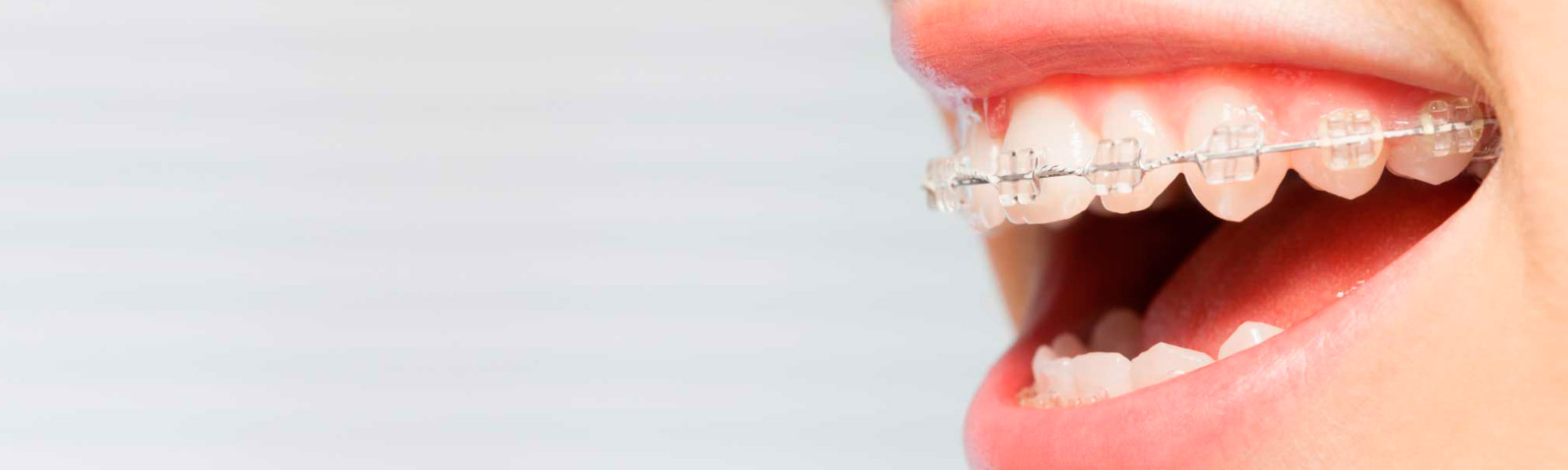 bracesheader